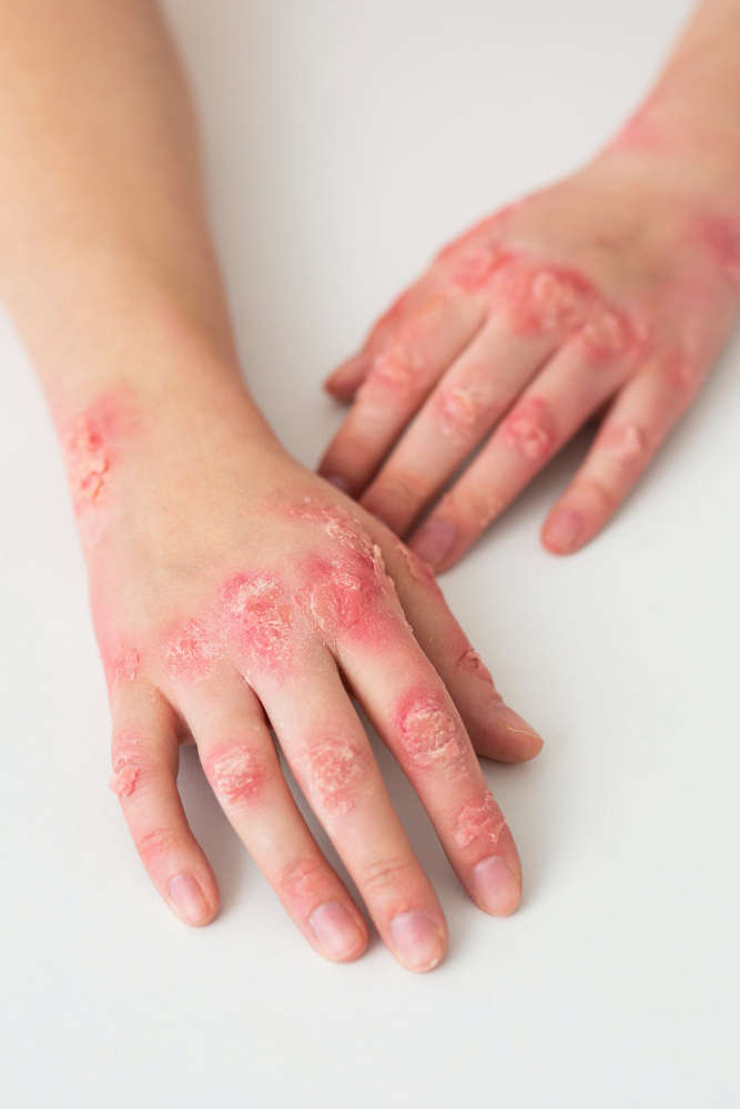 An image of someone with eczema.