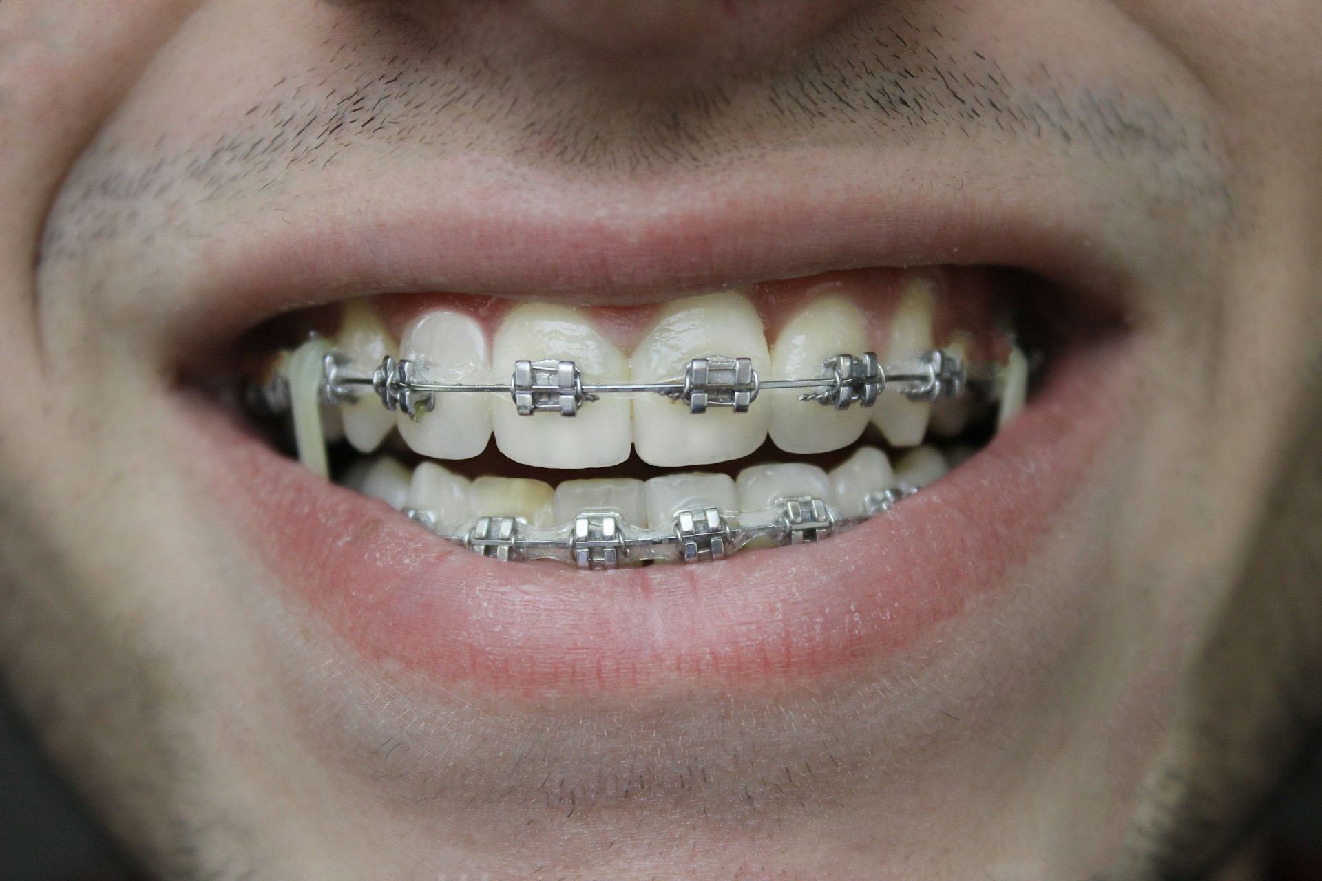 An image of someone with braces.